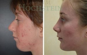 Rhinoplasty Patient 38