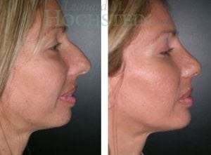 Rhinoplasty Patient 39