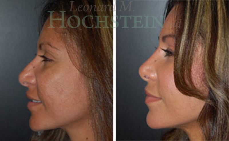 Rhinoplasty Patient