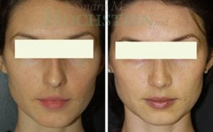 Rhinoplasty Patient