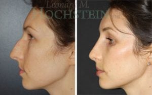 Rhinoplasty Patient