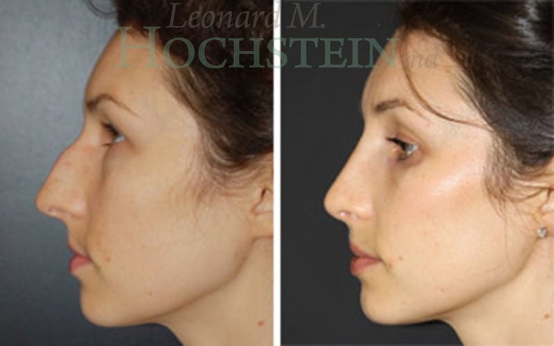 Rhinoplasty Patient