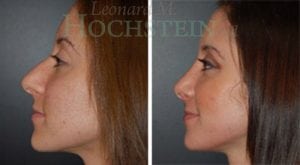 Rhinoplasty Patient