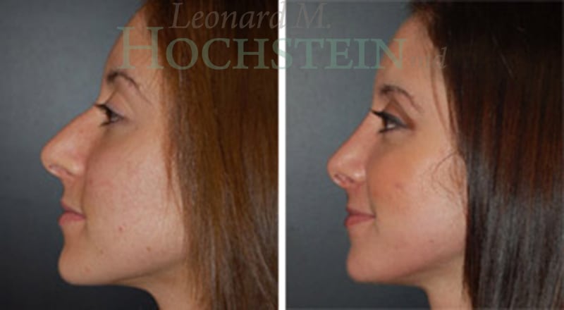Rhinoplasty Patient