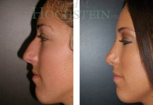 Rhinoplasty Patient