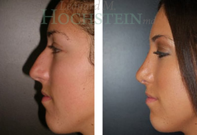 Rhinoplasty Patient