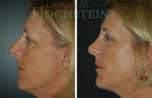 Rhinoplasty Patient 44