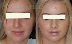 Rhinoplasty Patient