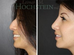 Rhinoplasty Patient