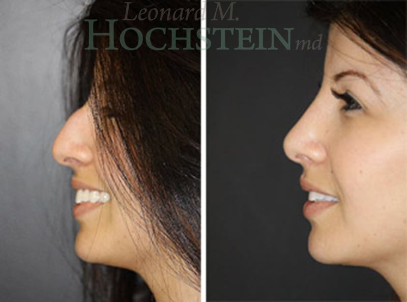 Rhinoplasty Patient