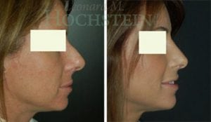 Rhinoplasty Patient 49