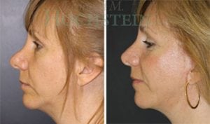 Rhinoplasty Patient 50