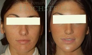 Rhinoplasty Patient