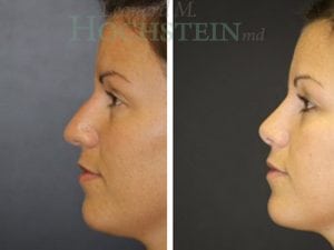 Rhinoplasty Patient