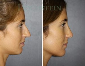 Rhinoplasty Patient