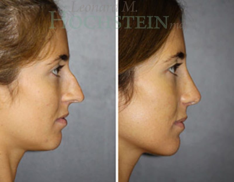 Rhinoplasty Patient