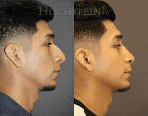 Rhinoplasty Patient