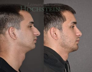 Rhinoplasty Patient