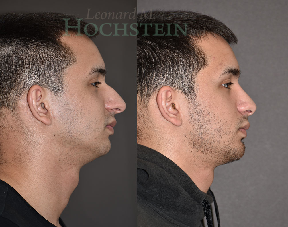 Rhinoplasty Patient