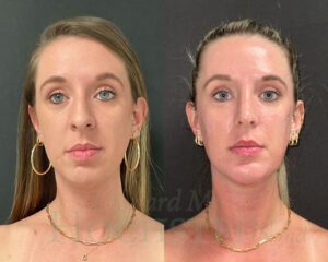 Chin Implant Patient