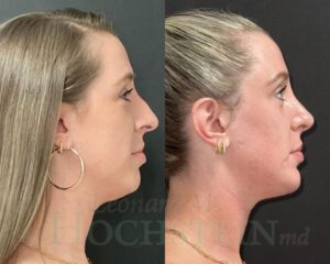 Chin Implant Patient