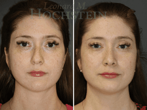 Rhinoplasty Patient