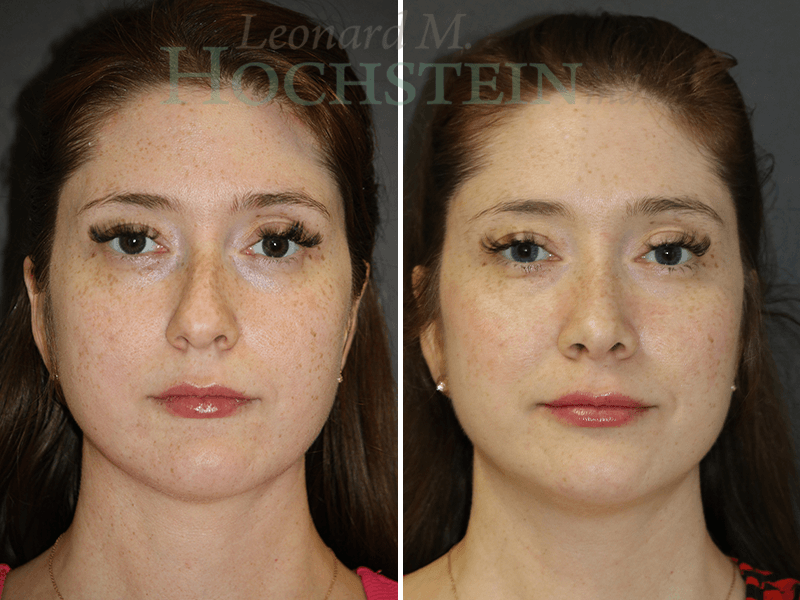 Rhinoplasty Patient