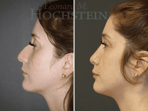 Rhinoplasty Patient