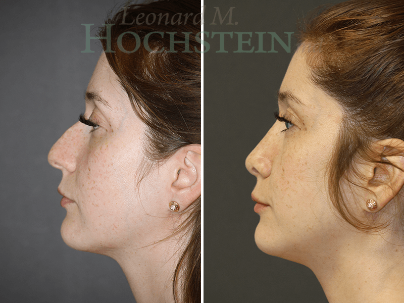 Rhinoplasty Patient