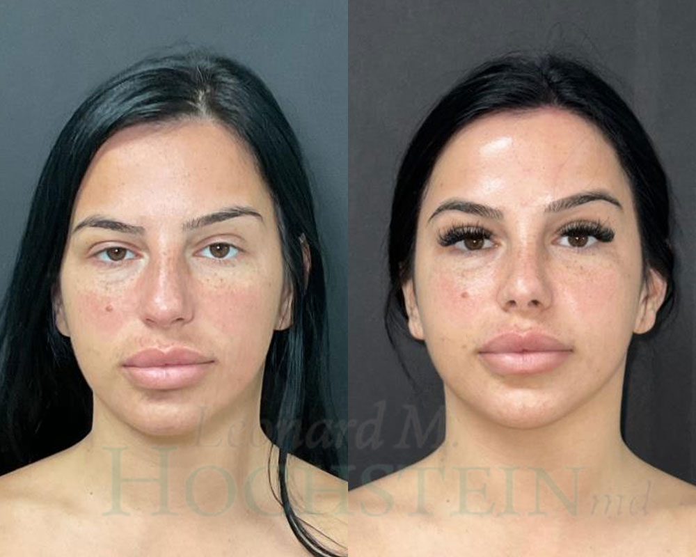 Rhinoplasty Patient