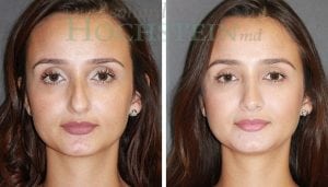 Rhinoplasty Patient
