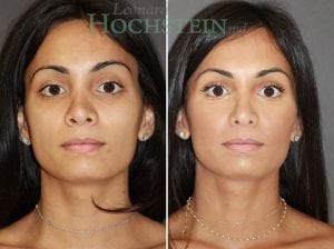 Rhinoplasty Patient