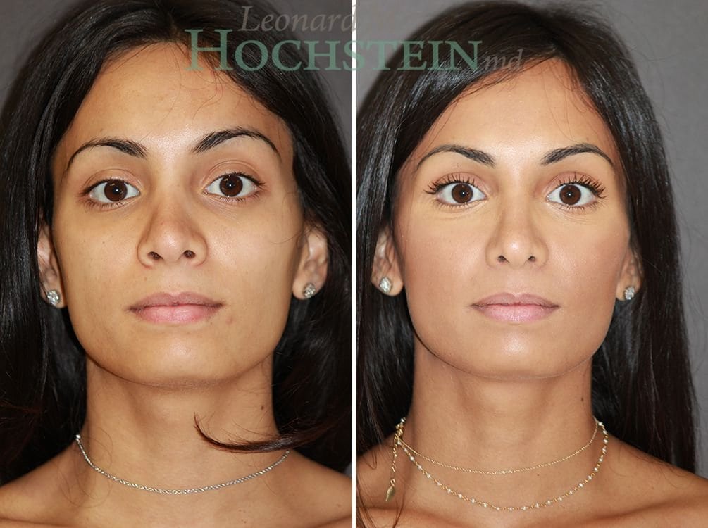 Rhinoplasty Patient