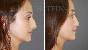 Rhinoplasty Patient