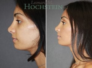 Rhinoplasty Patient