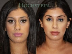 Rhinoplasty Patient