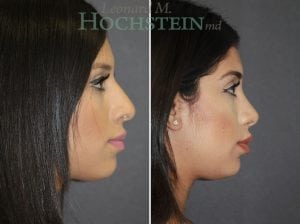 Rhinoplasty Patient