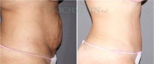 Tummy Tuck Patient