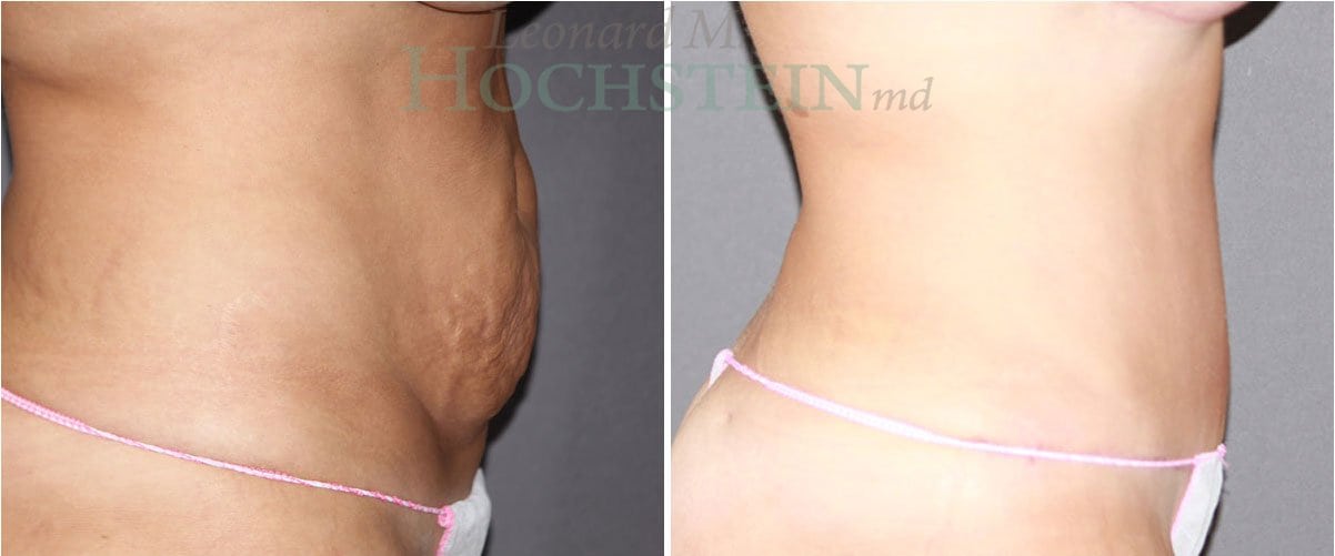 Tummy Tuck Patient