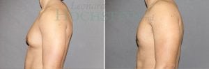 Gynecomastia Patient