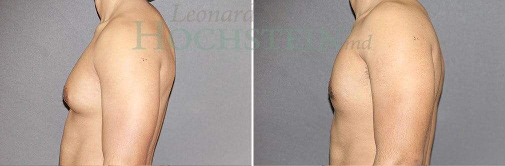Gynecomastia Patient
