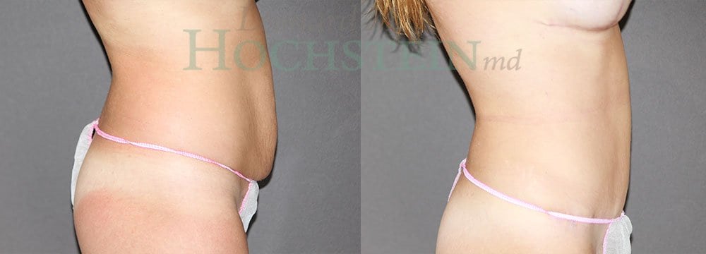 Tummy Tuck Patient