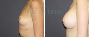 Breast Augmentation Patient