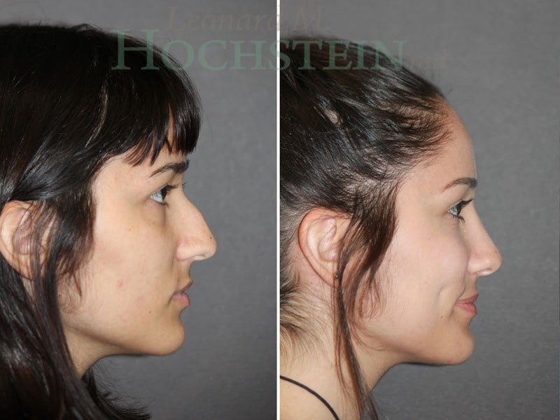 Rhinoplasty Patient