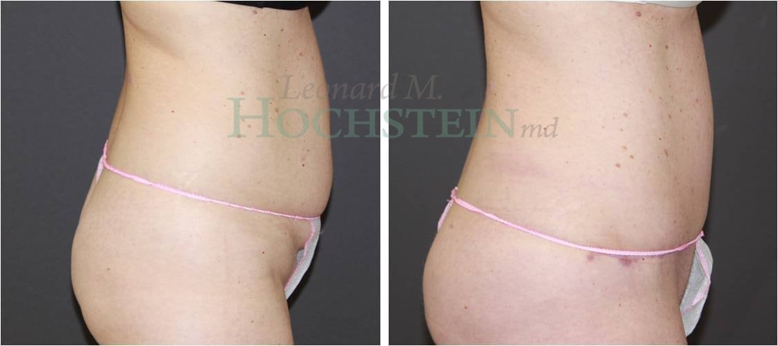 Tummy Tuck Patient