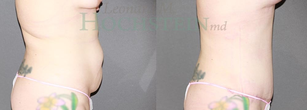 Tummy Tuck Patient
