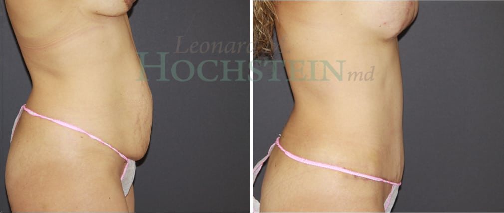 Mommy Makeover Patient