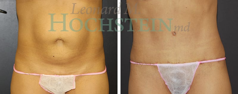Tummy Tuck Patient