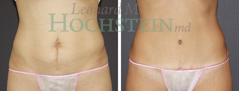 Tummy Tuck Patient