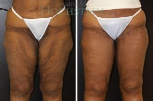 Thigh Lift Patient